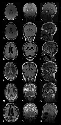 Electroclinical Features of Epilepsy in Mucopolysaccharidosis III: Outcome Description in a Cohort of 15 Italian Patients